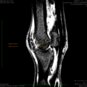 Horses in the MSC group had lower MRI Whole-Organ Magnetic Resonance Imaging Scores and lower radiographic Osteo-arthritis scores